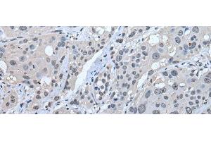 Immunohistochemistry of paraffin-embedded Human esophagus cancer tissue using STRADA Polyclonal Antibody at dilution of 1:45(x200) (STRADA 抗体)