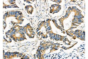 ABIN6260901 and ABIN6276686 at 1/100 staining Human colorectal cancer by IHC-P. (Clusterin 抗体  (Internal Region))