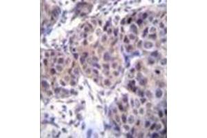 Formalin fixed and paraffin embedded human breast carcinoma reacted with Dishevelled-3 / DVL3 Antibody (C-term) followed by peroxidase conjugation of the secondary antibody and DAB staining. (DVL3 抗体  (C-Term))