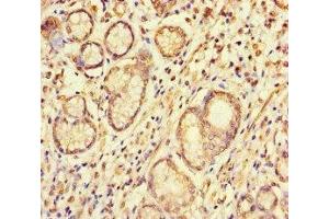 Immunohistochemistry of paraffin-embedded human gastric cancer using ABIN7166087 at dilution of 1:100 (S1G (AA 1-66) 抗体)