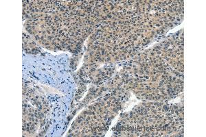 Immunohistochemistry of Human liver cancer using CRLF2 Polyclonal Antibody at dilution of 1:60 (CRLF2 抗体)