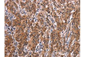 The image on the left is immunohistochemistry of paraffin-embedded Human gastic cancer tissue using ABIN7190640(FDCSP Antibody) at dilution 1/25, on the right is treated with synthetic peptide. (FDCSP 抗体)
