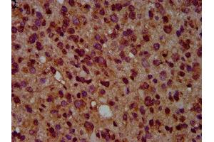 IHC image of ABIN7154699 diluted at 1:500 and staining in paraffin-embedded human glioma performed on a Leica BondTM system.