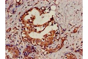 Immunohistochemistry of paraffin-embedded human breast cancer using ABIN7168837 at dilution of 1:100 (SENP2 抗体  (AA 138-324))