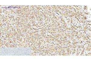 Immunohistochemistry of paraffin-embedded Human breast cancer tissue using Oct-1/2 Monoclonal Antibody at dilution of 1:200. (Oct-1/2 抗体)