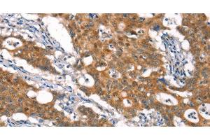 Immunohistochemistry of paraffin-embedded Human gasrtic cancer tissue using CYLD Polyclonal Antibody at dilution 1:35 (CYLD 抗体)