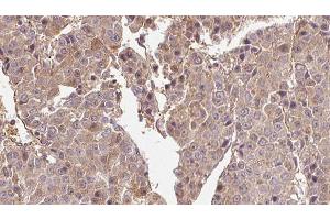 ABIN6274569 at 1/100 staining Human liver cancer tissue by IHC-P. (5HT1B Receptor 抗体  (Internal Region))