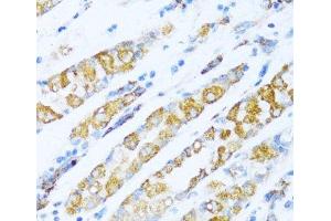 Immunohistochemistry of paraffin-embedded Human gastric cancer using NDUFA5 Polyclonal Antibody at dilution of 1:100 (40x lens). (NDUFA5 抗体)
