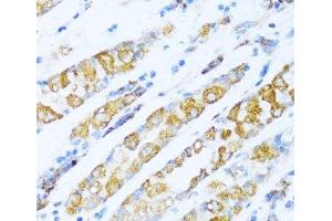 Immunohistochemistry of paraffin-embedded Human gastric cancer using NDUFA5 Polyclonal Antibody at dilution of 1:100 (40x lens). (NDUFA5 抗体)
