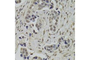 Immunohistochemistry of paraffin-embedded human breast cancer using INTS6 Antibody (ABIN2563455) at dilution of 1:100 (40x lens). (INTS6 抗体)