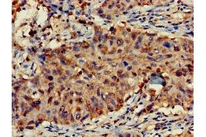 Immunohistochemistry of paraffin-embedded human lung cancer using ABIN7143032 at dilution of 1:100 (FAM17A (AA 1-144) 抗体)