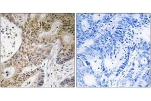 Immunohistochemistry analysis of paraffin-embedded human colon carcinoma tissue, using PRPF6 Antibody. (PRP6/ANT-1 抗体  (AA 747-796))