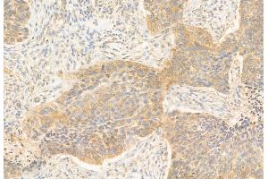 ABIN6264686 and ABIN6272906 at 1/100 staining Human lung cancer by IHC-P. (REEP5 抗体  (N-Term))