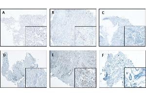 CTSL expression in normal and tumor tissues of the lung and breast. (Cathepsin L 抗体  (AA 114-288))