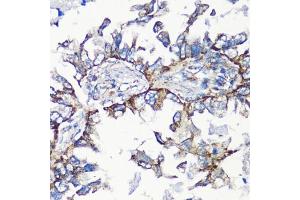 Immunohistochemistry of paraffin-embedded human lung cancer using MMP16 antibody (ABIN6132356, ABIN6143906, ABIN6143907 and ABIN6214654) at dilution of 1:100 (40x lens). (MMP16 抗体  (AA 290-565))
