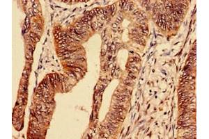 Immunocytochemistry analysis of human colon cancer using ABIN7172795 at dilution of 1:100 (Transferrin Receptor 抗体  (AA 94-754))