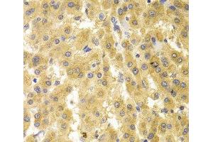 Immunohistochemistry of paraffin-embedded Human liver cancer using GMNN Polyclonal Antibody at dilution of 1:100 (40x lens). (Geminin 抗体)
