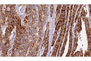 ABIN6267145 at 1/100 staining Human thyroid cancer tissue by IHC-P.