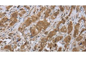 Immunohistochemistry of paraffin-embedded Human breast cancer tissue using CLPS Polyclonal Antibody at dilution 1:45 (CLPS 抗体)