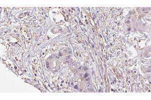 ABIN6273953 at 1/100 staining Human liver cancer tissue by IHC-P. (NPY4R 抗体  (N-Term))