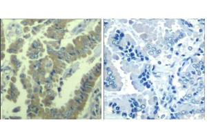 Immunohistochemical analysis of paraffin-embedded human lung carcinoma tissue using MARCKS (phospho-Ser170) Antibody (E011535). (MARCKS 抗体  (pSer170))