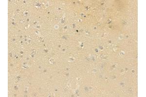 ABIN6264565 and ABIN6279732 at 1/100 staining human glioblastoma by IHC-P.