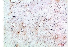 Immunohistochemical analysis of paraffin-embedded human-cervical-cancer, antibody was diluted at 1:200 (TNIP2 抗体  (AA 61-110))