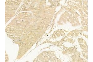 ABIN6262540 and ABIN6278895 at 1/100 staining human tongue carcinoma by IHC-P. (IL17F 抗体  (Internal Region))