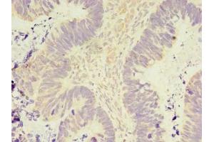 Immunohistochemistry of paraffin-embedded human ovarian cancer using ABIN7165911 at dilution of 1:100 (PELO 抗体  (AA 1-385))