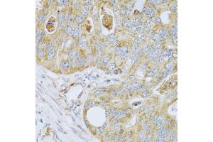 Immunohistochemistry of paraffin-embedded human colon carcinoma using PSG1 antibody. (PSG1 抗体)