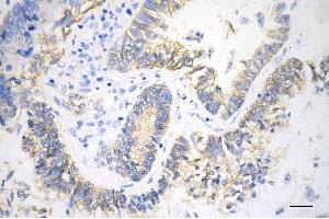 Immunohistochemistry was performed on paraffin-embedded human sigmoid colon carcinoma using catenin beta 1 antibody (ABIN7797929), 1:100). (CTNNB1 抗体)