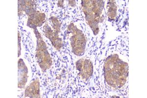 IHC testing of FFPE human breast cancer with SMN1/2 antibody. (SMN1 / SMN2 抗体)