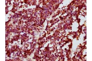 IHC image of ABIN7127685 diluted at 1:100 and staining in paraffin-embedded human lung cancer performed on a Leica BondTM system. (Recombinant CREB1 抗体  (pSer133))