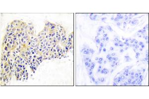 Immunohistochemical analysis of paraffin-embedded human breast carcinoma tissue using HSP90B (Ab-254) antibody. (HSP90AB1 抗体)