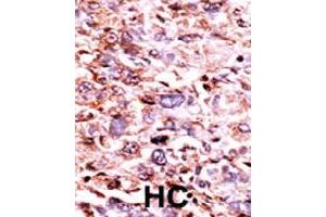 Formalin-fixed and paraffin-embedded human hepatocellular carcinoma tissue reacted with CHEK1 (phospho S280) polyclonal antibody  which was peroxidase-conjugated to the secondary antibody followed by AEC staining.