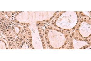 Immunohistochemistry of paraffin-embedded Human thyroid cancer tissue using KDM7A Polyclonal Antibody at dilution of 1:35(x200) (JHDM1D 抗体)