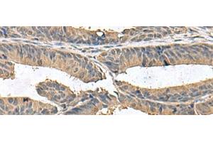 Immunohistochemistry of paraffin-embedded Human colorectal cancer tissue using ZG16 Polyclonal Antibody at dilution of 1:95(x200) (ZG16 抗体)