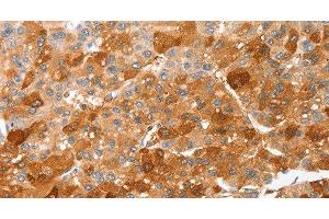 Immunohistochemistry of paraffin-embedded Human liver cancer using CIDEC Polyclonal Antibody at dilution of 1:50 (CIDEC 抗体)