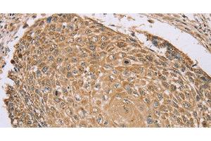 Immunohistochemistry of paraffin-embedded Human lung cancer tissue using RNF148 Polyclonal Antibody at dilution 1:45 (RNF148 抗体)