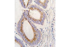 Formalin-fixed and paraffin-embedded human colon carcinoma tissue reacted with GDF11 antibody (N-term) (ABIN388814 and ABIN2839133) , which was peroxidase-conjugated to the secondary antibody, followed by DAB staining. (GDF11 抗体  (N-Term))