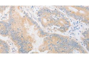 Immunohistochemistry of paraffin-embedded Human colon cancer using CD24 Polyclonal Antibody at dilution of 1:40 (CD24 抗体)