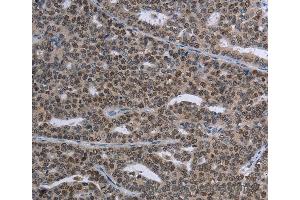 Immunohistochemistry of Human thyroid cancer using MAGEC1 Polyclonal Antibody at dilution of 1:30 (MAGEC1 抗体)