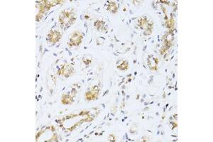 Immunohistochemistry of paraffin-embedded human breast cancer using ETV1 antibody (ABIN6291698) at dilution of 1:100 (40x lens). (ETV1 抗体)