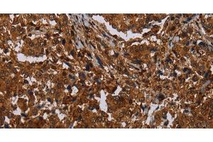 Immunohistochemistry of paraffin-embedded Human liver cancer tissue using MAGEB18 Polyclonal Antibody at dilution 1:30 (MAGEB18 抗体)