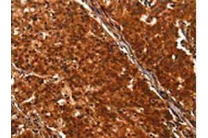 The image on the left is immunohistochemistry of paraffin-embedded Human gastric cancer tissue using ABIN7190469(DHH Antibody) at dilution 1/25, on the right is treated with synthetic peptide. (desert Hedgehog 抗体)