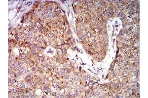 Immunohistochemical analysis of paraffin-embedded bladder cancer tissues using EIF5 mouse mAb with DAB staining. (EIF5 抗体  (AA 1-300))