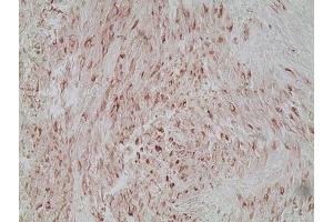 Immunohistochemistry analysis of human melanoma skin tissue using Melanoma marker (human) mAb (HMB45), (ABIN7211713) at a dilution of 1:20. (Melanoma Marker 抗体)