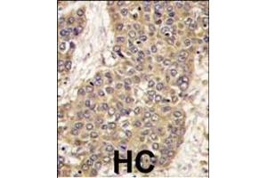 Formalin-fixed and paraffin-embedded human hepatocarcinoma tissue reacted with CASP6 antibody (C-term), which was peroxidase-conjugated to the secondary antibody, followed by DAB staining. (Caspase 6 抗体  (C-Term))