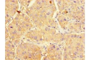 Immunohistochemistry of paraffin-embedded human liver cancer using ABIN7175166 at dilution of 1:100 (UGP2 抗体  (AA 1-497))