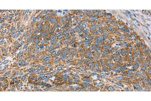 Immunohistochemistry of paraffin-embedded Human cervical cancer tissue using CENPO Polyclonal Antibody at dilution 1:40 (CENPO 抗体)